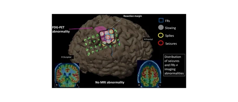 An example of a multimodal approach that integrates neuroimaging data, reconstructed 3D MRI and FDG-PET scan, with EEG findings.