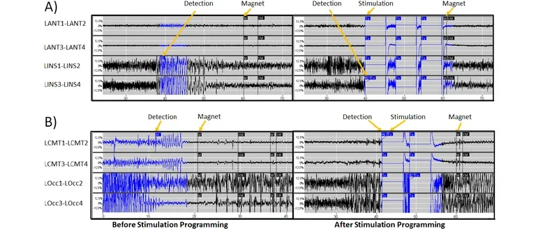 Examples of EEG recordings from a responsive neurostimulation (RNS) device.