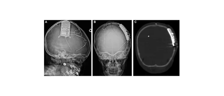  A skull X-ray and low-dose CT scan showing an implanted responsive neurostimulation (RNS) device in a pediatric patient.