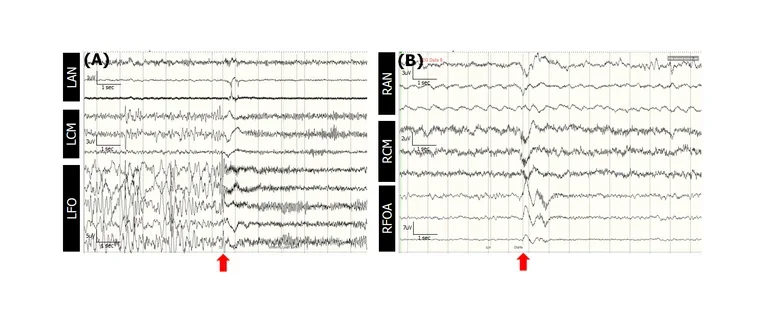 Stereotactic EEG (SEEG) recording of a seizure showing involvement of thalamic contacts, specifically LAN and LCM.