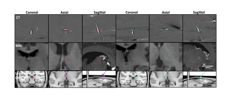 SEEG electrode coregistration showing electrode contacts precisely targeted within thalamic nuclei.