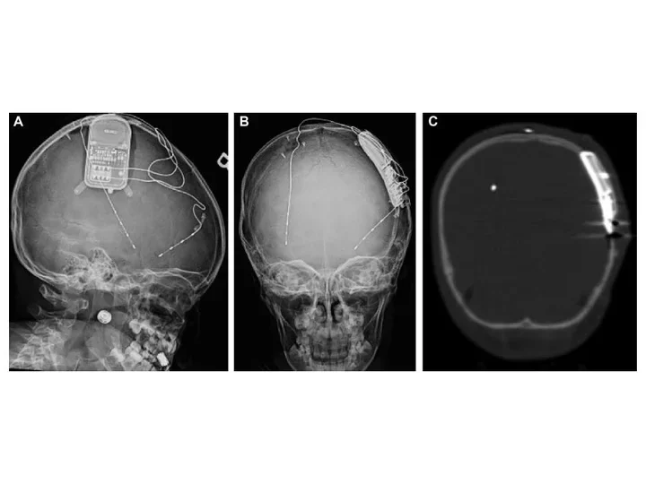  A skull X-ray and low-dose CT scan showing an implanted responsive neurostimulation (RNS) device in a pediatric patient.